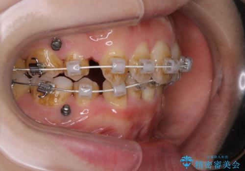 ワイヤー矯正治療中のPMTC60分コースでステインをキレイにの治療前
