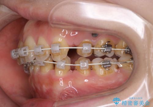 ワイヤー矯正治療中のPMTC60分コースでステインをキレイにの症例 治療前
