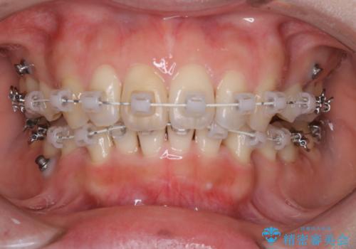ワイヤー矯正治療中のPMTC60分コースでステインをキレイにの治療後