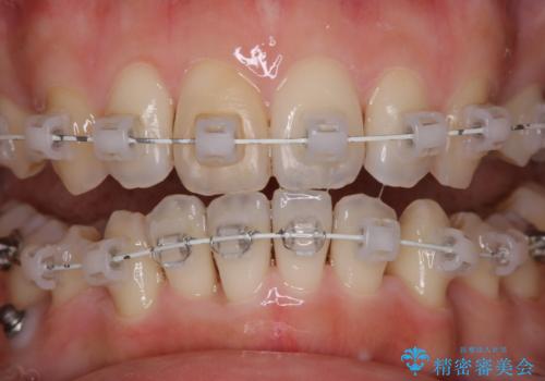ワイヤー矯正治療中のPMTC60分コースでステインをキレイにの治療後