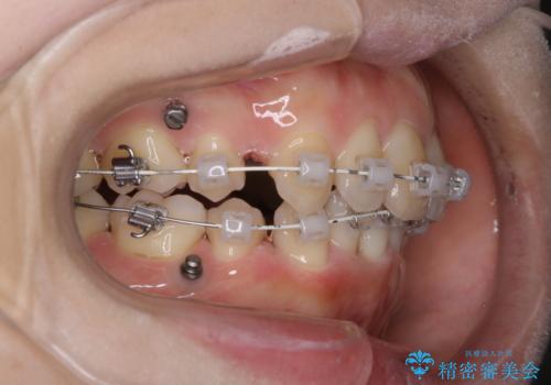 ワイヤー矯正治療中のPMTC60分コースでステインをキレイにの治療後