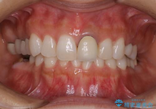 今後ホワイトニング予定の方のPMTCの治療前