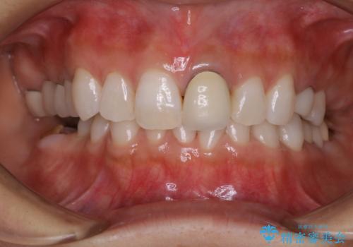 今後ホワイトニング予定の方のPMTCの治療後