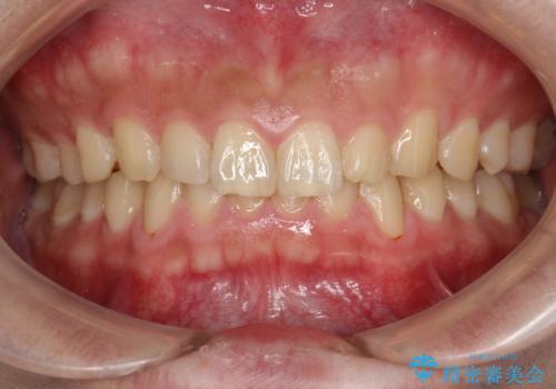 60分のPMTCで歯の黄ばみをきれいに除去の治療前