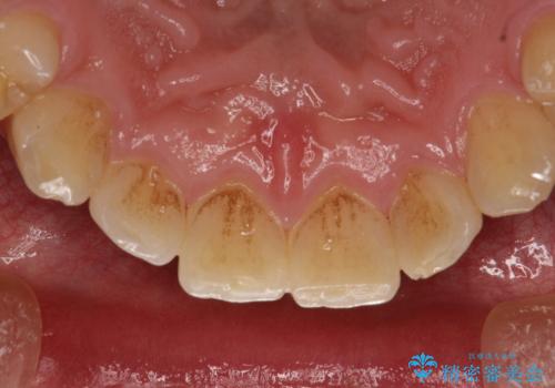 60分のPMTCで歯の黄ばみをきれいに除去の症例 治療前