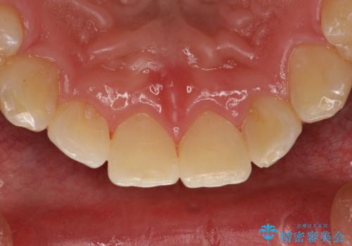 60分のPMTCで歯の黄ばみをきれいに除去の症例 治療後