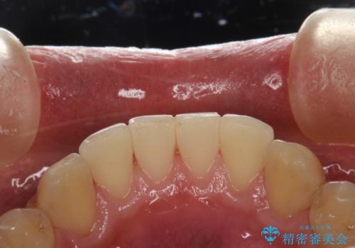 60分のPMTCで歯の黄ばみをきれいに除去の治療後