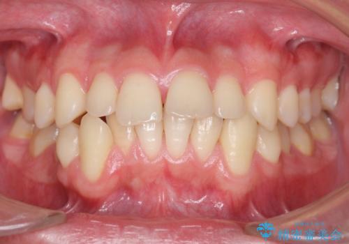 すきっ歯・出っ歯が気になる　インビザライン矯正　乳歯をインプラントにの症例 治療前
