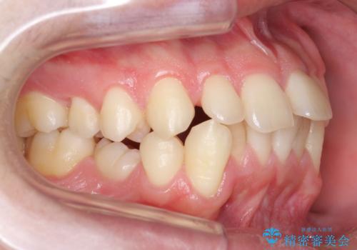 すきっ歯・出っ歯が気になる　インビザライン矯正　乳歯をインプラントに