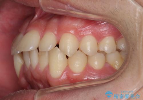 すきっ歯・出っ歯が気になる インビザライン矯正 乳歯をインプラントにの治療前