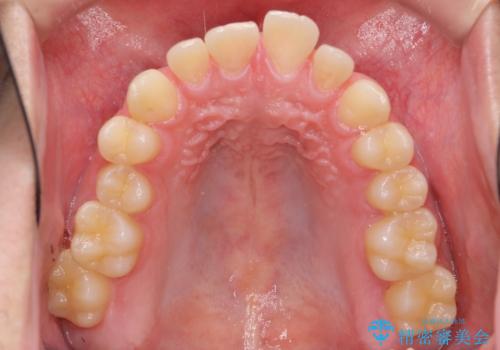すきっ歯・出っ歯が気になる　インビザライン矯正　乳歯をインプラントにの治療前