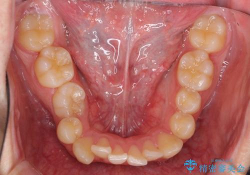 すきっ歯・出っ歯が気になる インビザライン矯正 乳歯をインプラントにの治療前