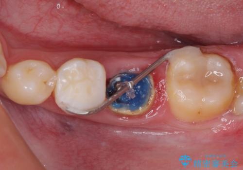 深い虫歯で歯茎が腫れる 部分矯正を用いたむし歯治療の治療中