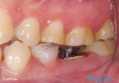 深い虫歯で歯茎が腫れる　部分矯正を用いたむし歯治療の治療中