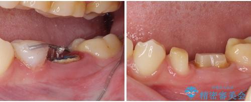 深い虫歯で歯茎が腫れる 部分矯正を用いたむし歯治療の治療中