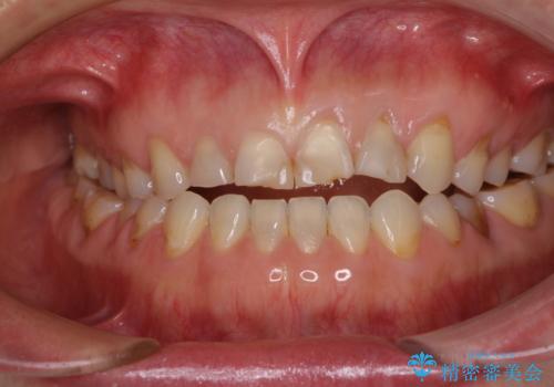 欠けてガタガタの前歯 オールセラミッククラウンによる補綴治療の治療前