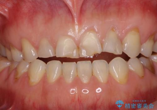 欠けてガタガタの前歯 オールセラミッククラウンによる補綴治療の治療前