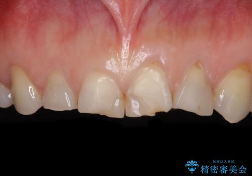 欠けてガタガタの前歯 オールセラミッククラウンによる補綴治療の症例 治療前