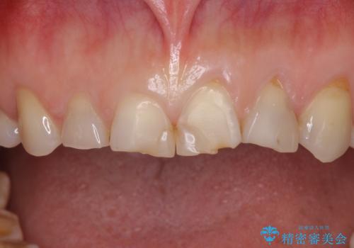 欠けてガタガタの前歯 オールセラミッククラウンによる補綴治療の治療前