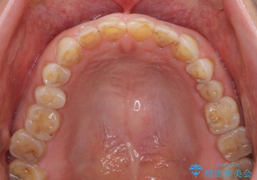 欠けてガタガタの前歯 オールセラミッククラウンによる補綴治療の治療前