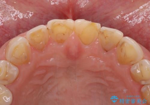 欠けてガタガタの前歯 オールセラミッククラウンによる補綴治療の治療前