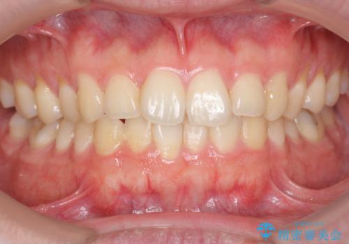 ホワイトニングで歯を白く!の治療前