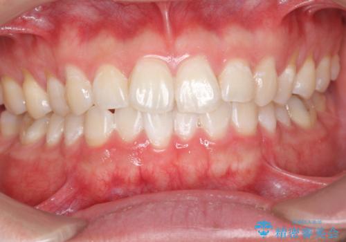 ホワイトニングで歯を白く!の治療後