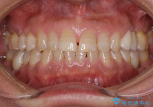 短期間で集中的に全顎治療