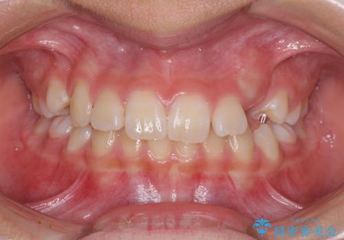 埋もれた犬歯を引っ張り出す 小学生のⅠ期治療の治療前