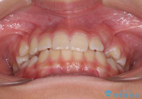 埋もれた犬歯を引っ張り出す 小学生のⅠ期治療の治療前