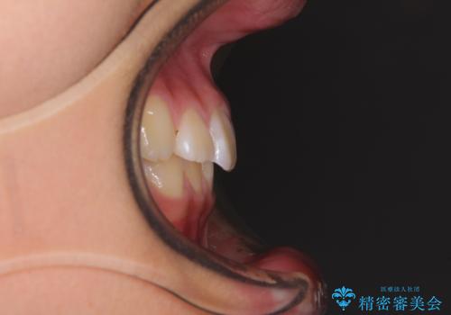 埋もれた犬歯を引っ張り出す 小学生のⅠ期治療の治療前