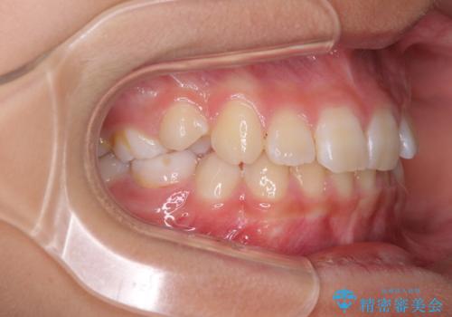 埋もれた犬歯を引っ張り出す 小学生のⅠ期治療の治療前