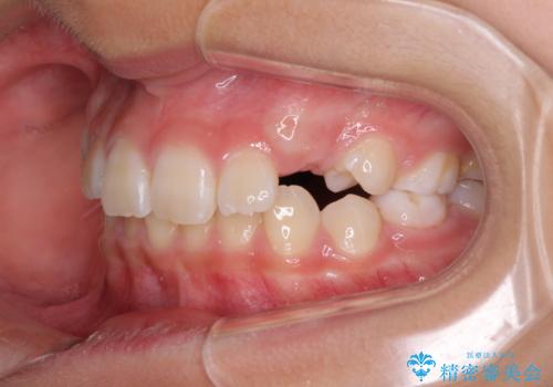 埋もれた犬歯を引っ張り出す　小学生のⅠ期治療の治療前