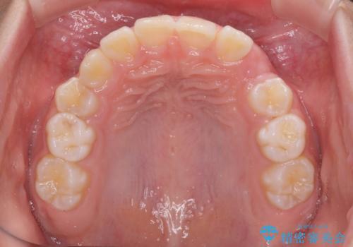 埋もれた犬歯を引っ張り出す 小学生のⅠ期治療の治療前