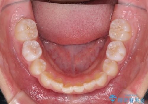 埋もれた犬歯を引っ張り出す 小学生のⅠ期治療の治療前