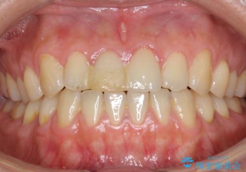 歯が折れた セラミックで綺麗に 30代女性の治療前