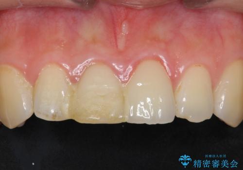 歯が折れた セラミックで綺麗に 30代女性の症例 治療前