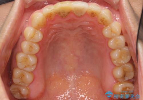 歯が折れた セラミックで綺麗に 30代女性の治療前