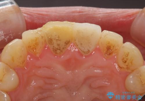 歯が折れた セラミックで綺麗に 30代女性の治療前