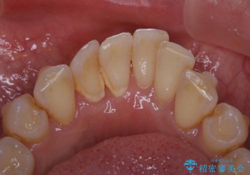 インビザライン中の歯石取り PMTCの治療前