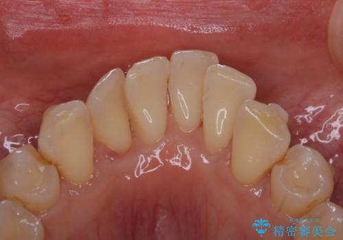 インビザライン中の歯石取り PMTCの治療後