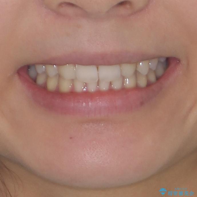 上顎前歯が2本欠損 インビザラインによる叢生の解消の治療後(顔貌)