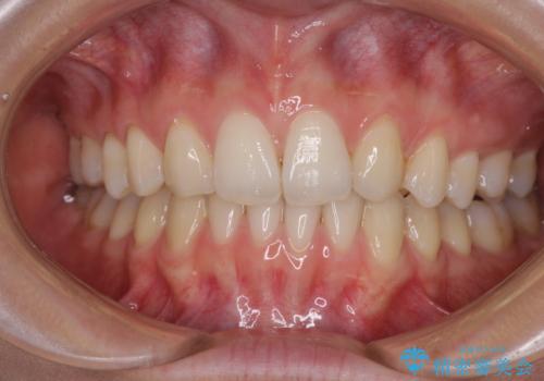 上顎前歯が2本欠損　インビザラインによる叢生の解消の症例 治療後