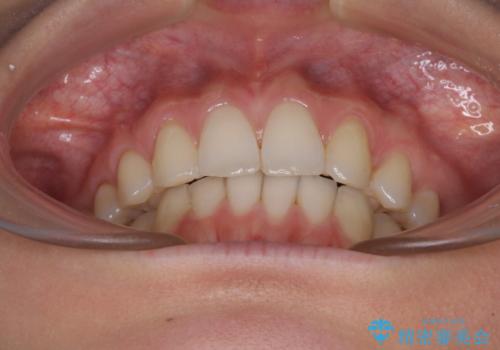 上顎前歯が2本欠損 インビザラインによる叢生の解消の治療後