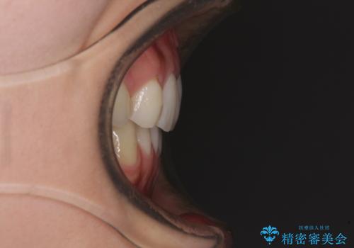 上顎前歯が2本欠損 インビザラインによる叢生の解消の治療後