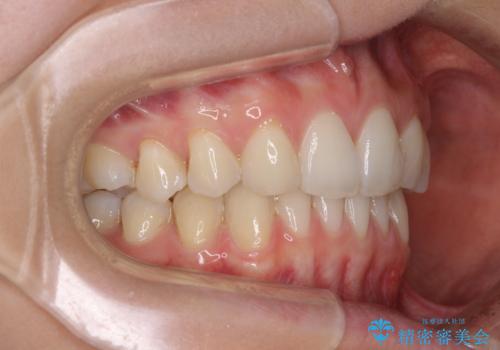 上顎前歯が2本欠損　インビザラインによる叢生の解消の治療後