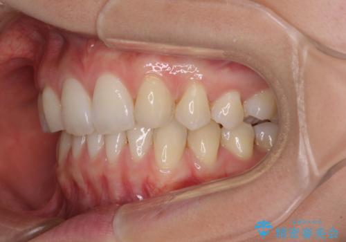上顎前歯が2本欠損 インビザラインによる叢生の解消の治療後