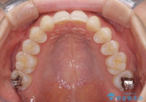 上顎前歯が2本欠損 インビザラインによる叢生の解消の治療後
