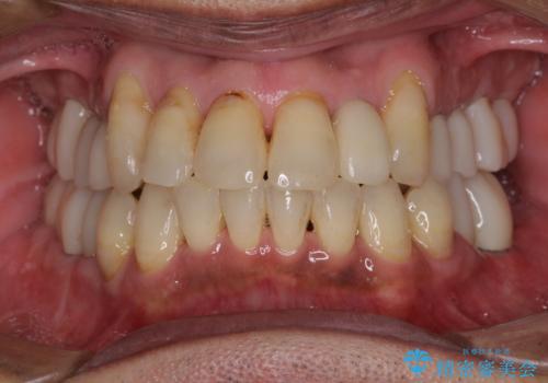 歯列不正と歯周病 総合歯科治療による全顎治療の症例 治療後