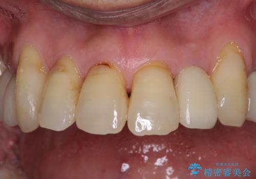 歯列不正と歯周病 総合歯科治療による全顎治療の治療後